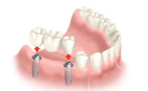 bridge de 3 unité sur implants