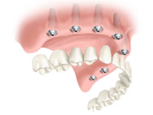 bridge complet sur implant