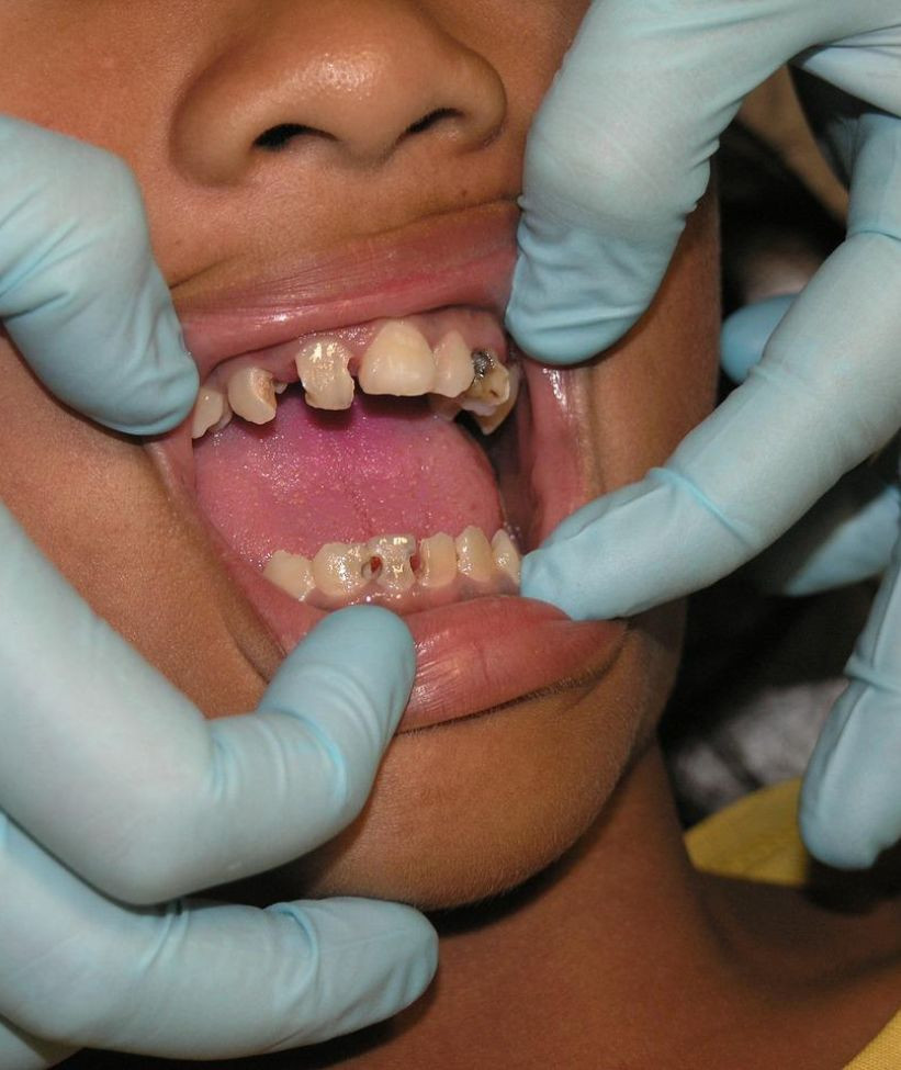 caries dentaires