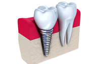 couronne dentaire sur implant