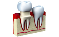 couronne dentaire sur racine