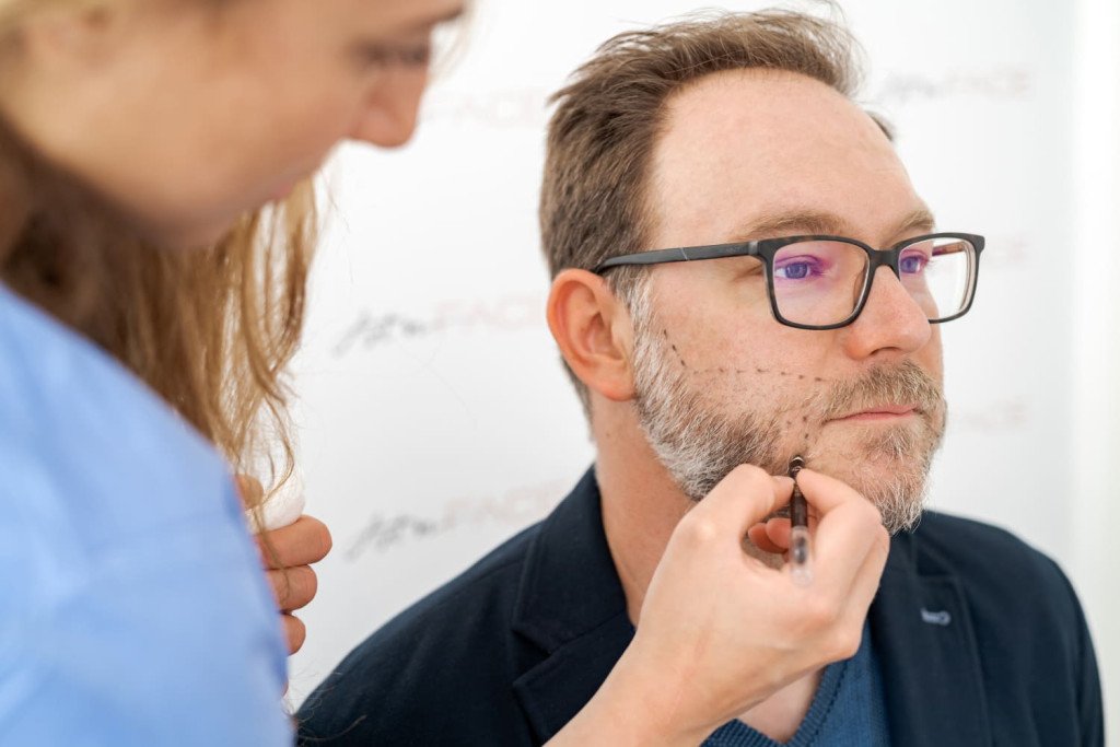 greffe de barbe avant