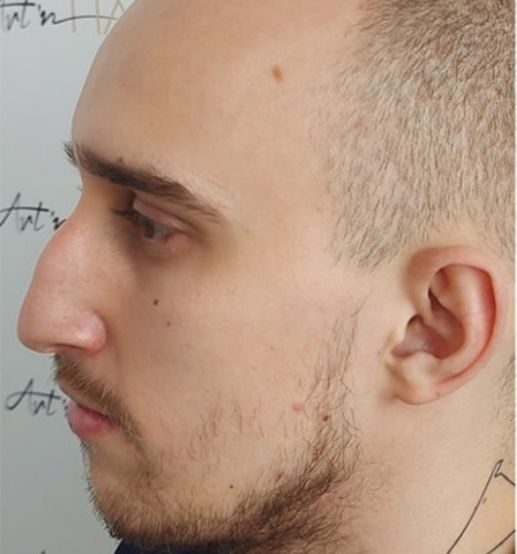 greffe de barbe avant