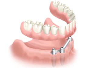 prothèse stabilisée sur implant