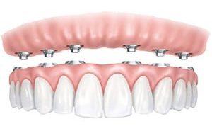 prothèse transvissée sur implant