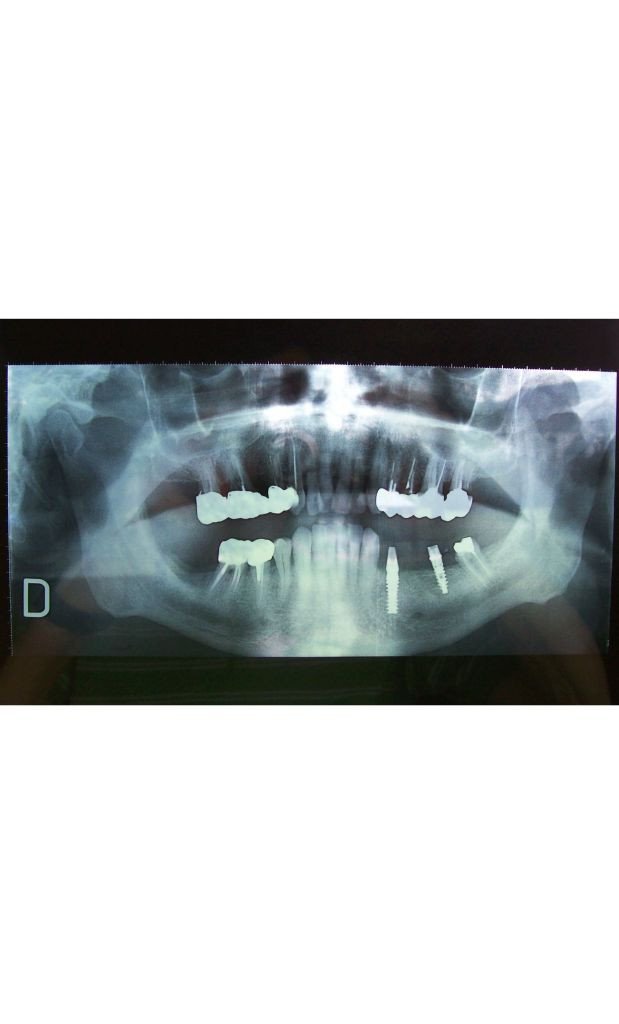 radio panoramique dentaire