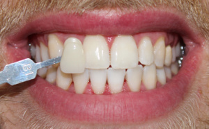 refaire ses dents blanchiment