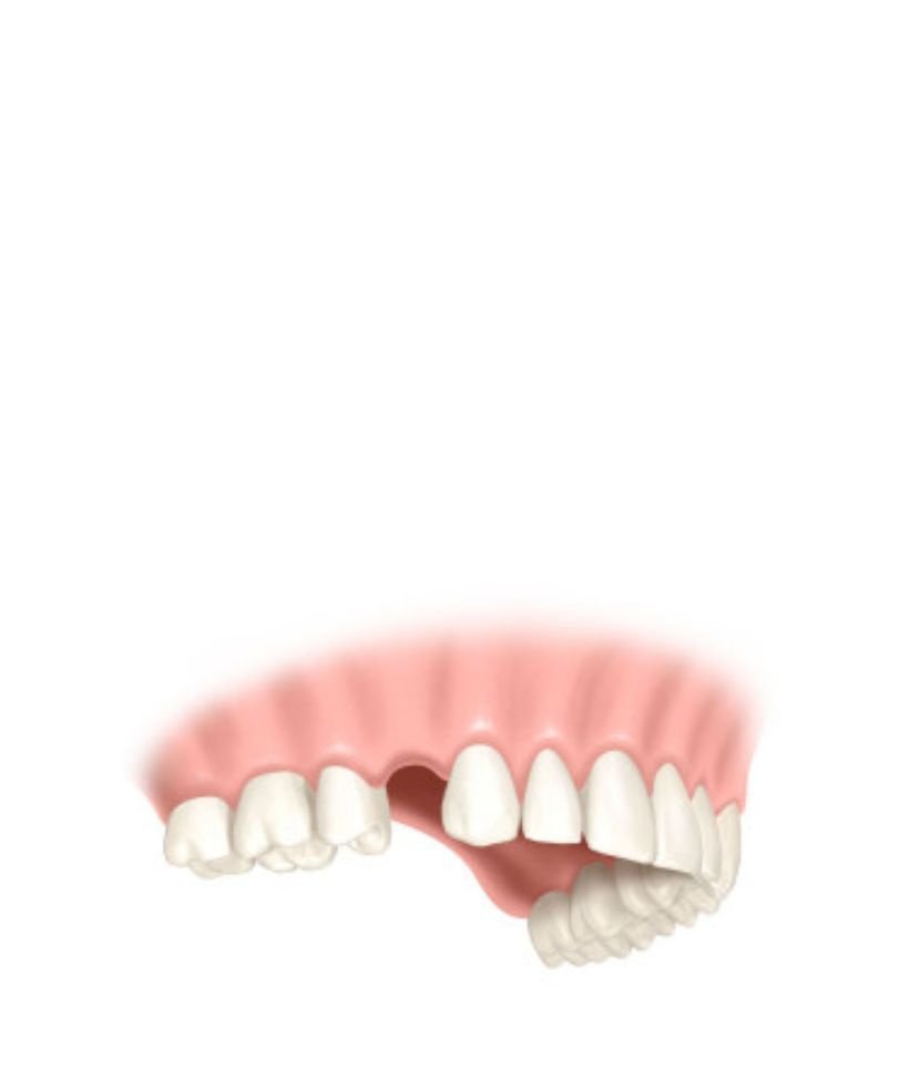 couronne dentaire sur implant bilan