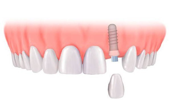 Couronne dentaire : Procédure, types et coûts expliqués en détail