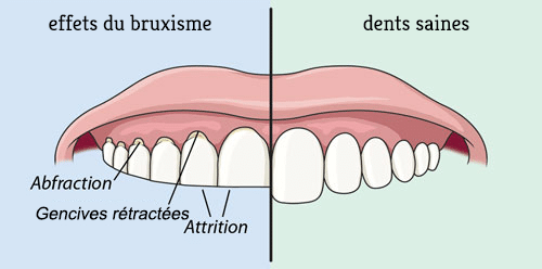 schema bruxisme