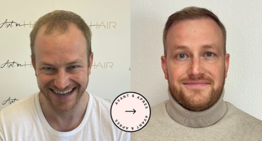 greffe de cheveux hongrie fabian