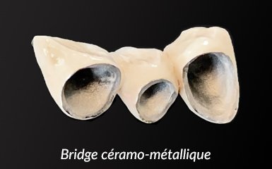 bridge céramo-métallique