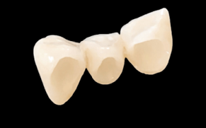 bridge céramo-zirconium