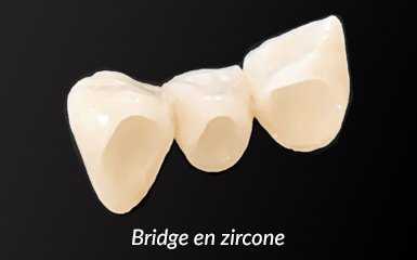 bridge en zircone