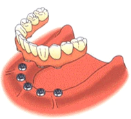 prothèse dentaire stabilisée boutons presson