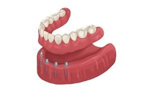 prothèse stabilisée sur implants