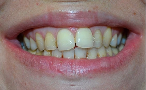 Refaire ses dents pas cher - Devis avec tarifs et photos avant-après