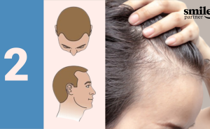 evolution alopecie stade 2