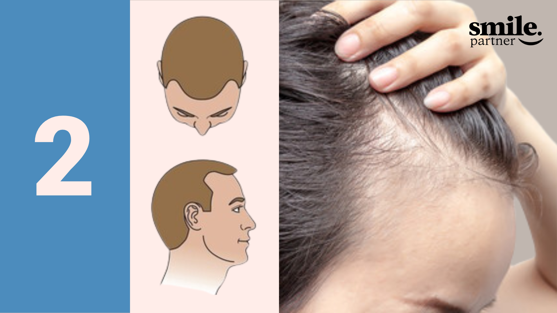 evolution alopecie stade 2