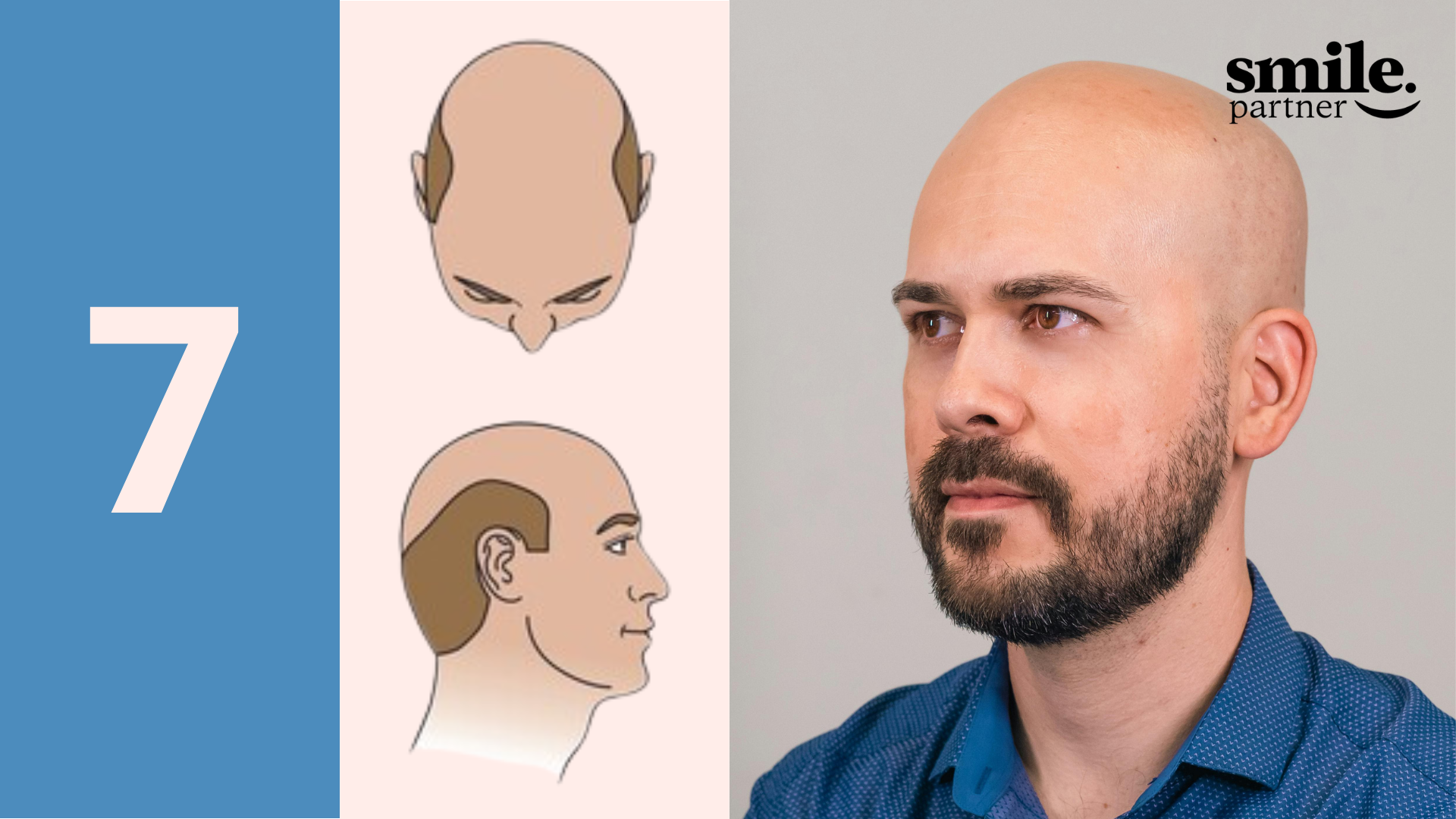 calvitie alopecie totale stade 7
