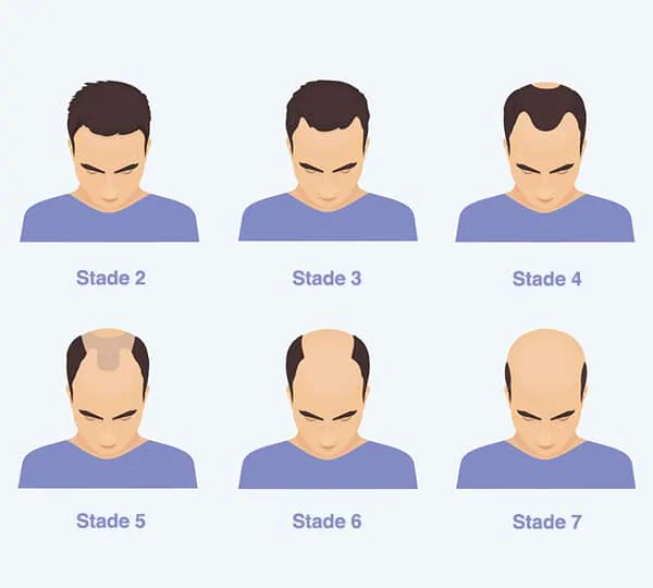 quand faire une greffe de cheveux