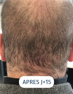 zone donneuse après 15 jours