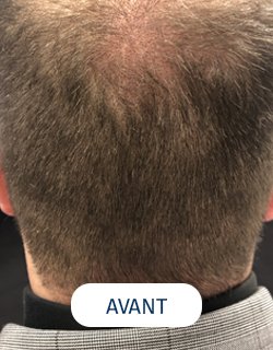 zone donneuse avant