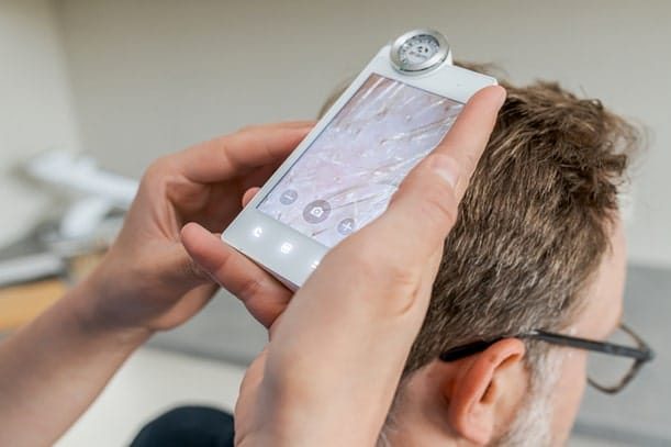 greffe de cheveux zone donneuse