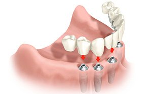 bridge complet sur implant dentaire