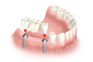 bridge dentaire sur implant