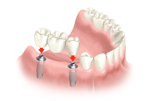 bridge dentaire sur implant