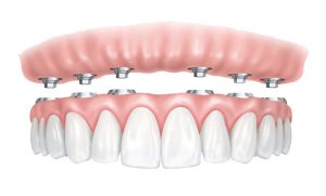 prothèse dentaire tranvissée sur implant