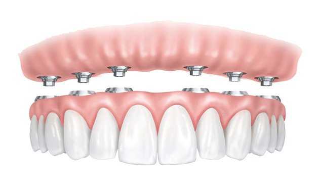 prothèse dentaire tranvissée sur implant