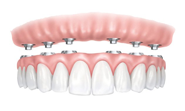 Dentier fixe sur implant - Dentier clipsé sur 4 implants 2925€ en 3 jours