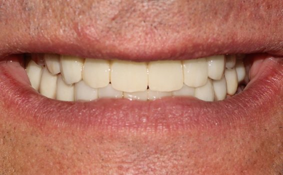 sourire marc après