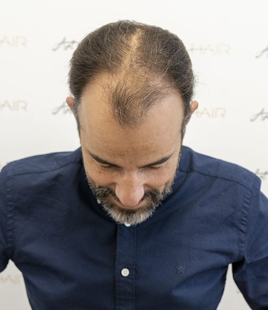 greffe de cheveux avant cédric
