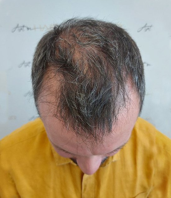 greffe de cheveux avant jérôme