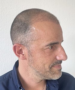 résultat greffe de cheveux après 2 mois Cédric