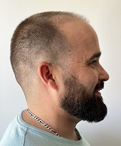 résultat greffe de cheveux après 2 mois david
