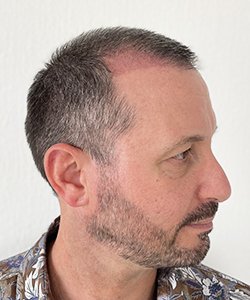 résultat greffe de cheveux après 2 mois jérôme