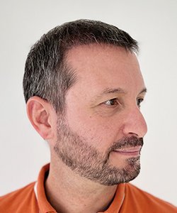 résultat greffe de cheveux après 3 mois jérôme