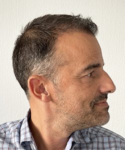 résultat greffe de cheveux après 6 mois Cédric