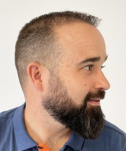 résultat greffe de cheveux après 6 mois david