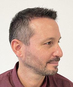 résultat greffe de cheveux après 6 mois jérôme