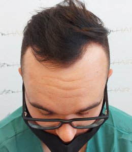 greffe de cheveux avant ben