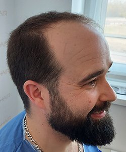 greffe de cheveux avant david