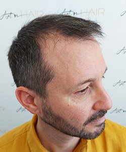 greffe de cheveux avant jérôme