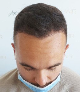 greffe de cheveux résultat après ben