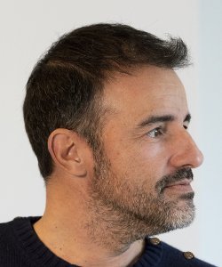 greffe de cheveux cédric 12 mois après