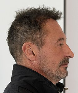 greffe de cheveux après 12 mois nicolas